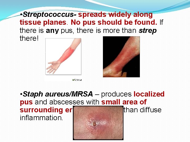  • Streptococcus- spreads widely along tissue planes. No pus should be found. If