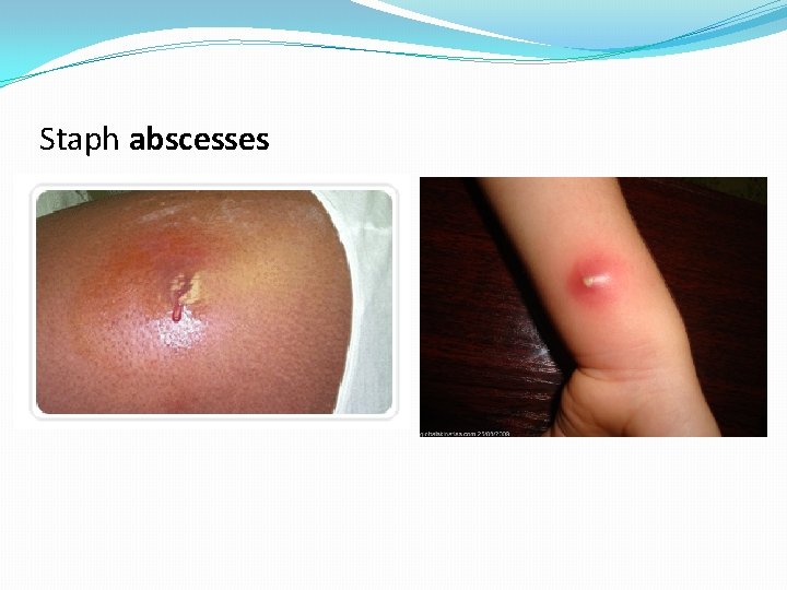 Staph abscesses 