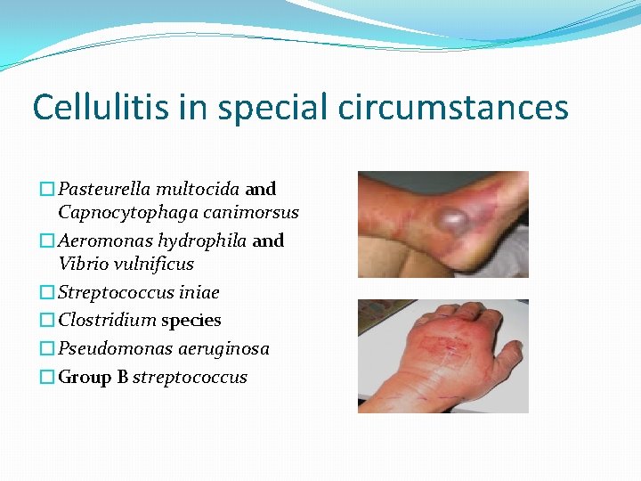 Cellulitis in special circumstances �Pasteurella multocida and Capnocytophaga canimorsus �Aeromonas hydrophila and Vibrio vulnificus