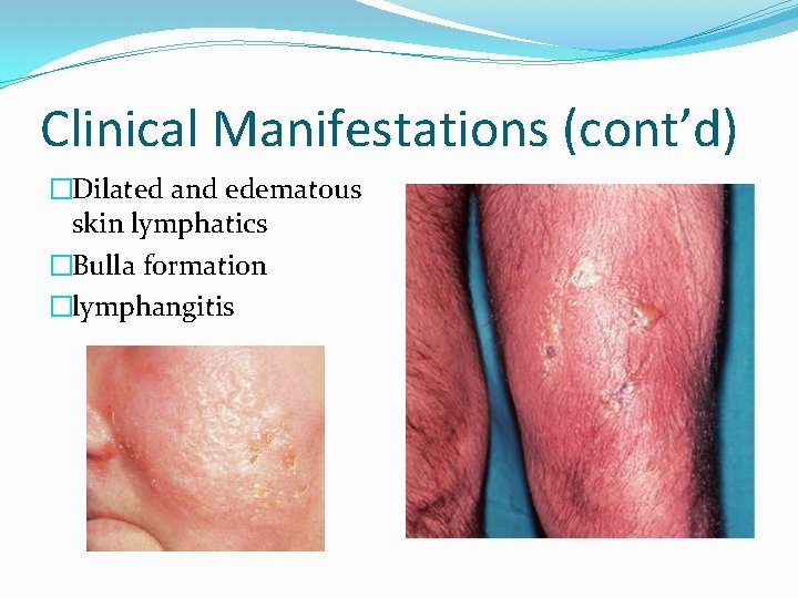 Clinical Manifestations (cont’d) �Dilated and edematous skin lymphatics �Bulla formation �lymphangitis 