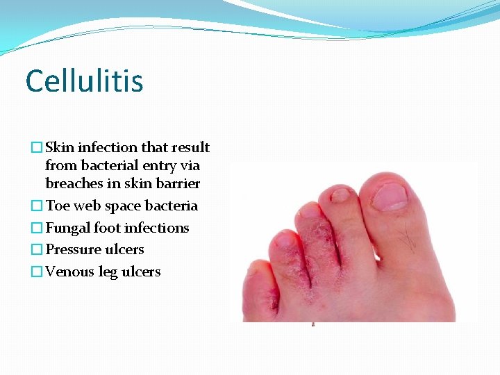 Cellulitis �Skin infection that result from bacterial entry via breaches in skin barrier �Toe