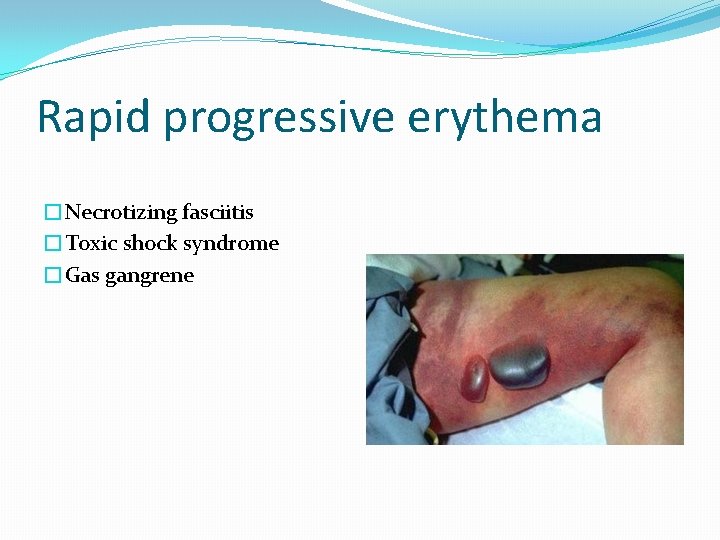 Rapid progressive erythema �Necrotizing fasciitis �Toxic shock syndrome �Gas gangrene 