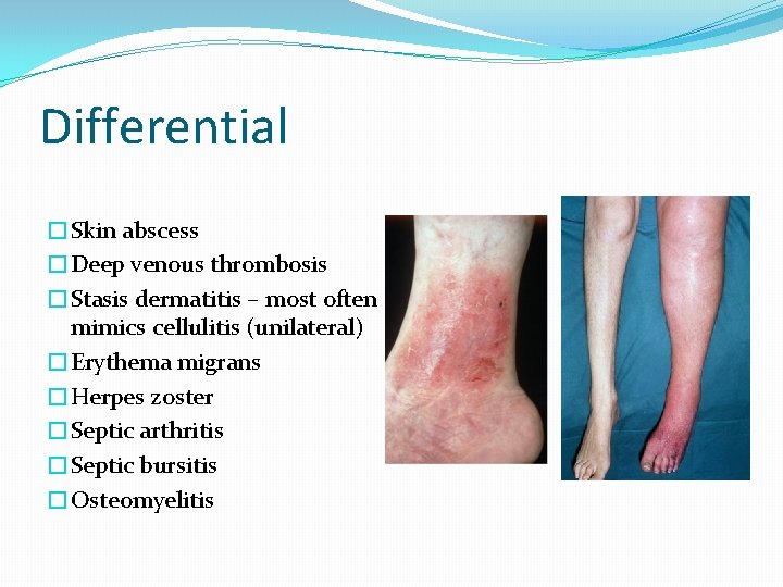 Differential �Skin abscess �Deep venous thrombosis �Stasis dermatitis – most often mimics cellulitis (unilateral)