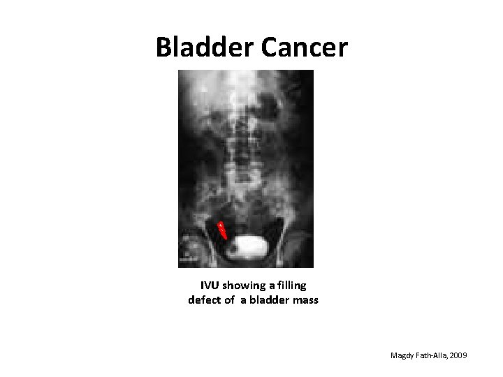 Bladder Cancer IVU showing a filling defect of a bladder mass Magdy Fath-Alla, 2009