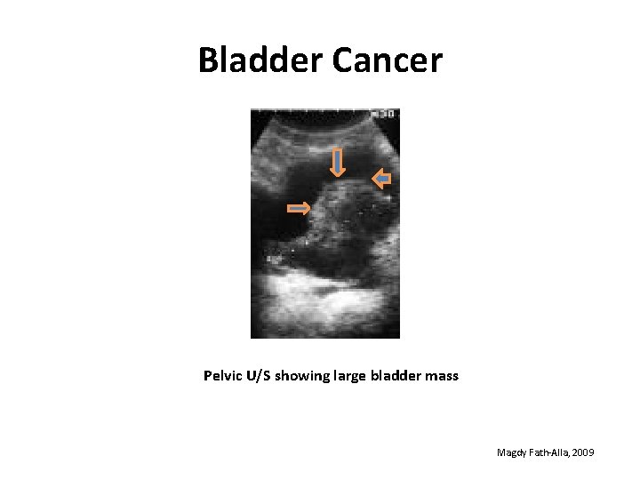 Bladder Cancer Pelvic U/S showing large bladder mass Magdy Fath-Alla, 2009 