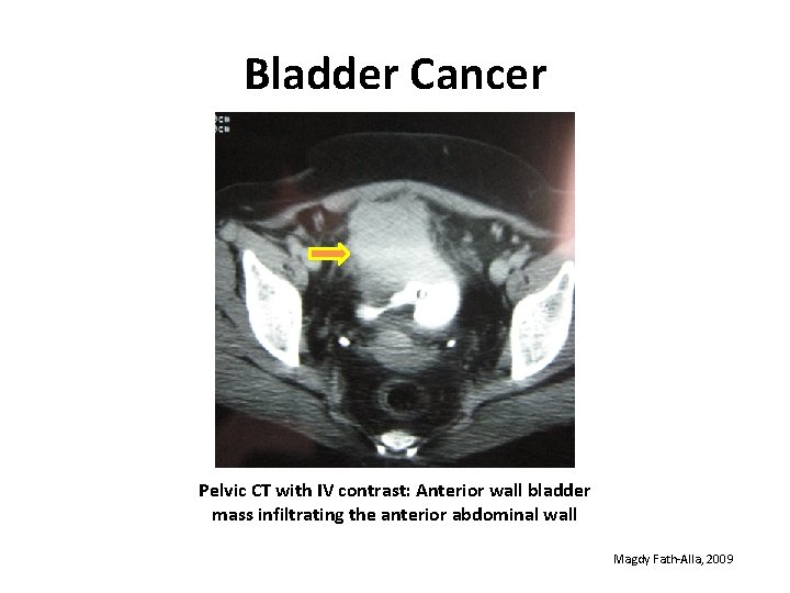 Bladder Cancer Pelvic CT with IV contrast: Anterior wall bladder mass infiltrating the anterior