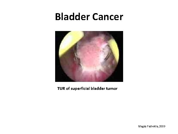 Bladder Cancer TUR of superficial bladder tumor Magdy Fath-Alla, 2009 