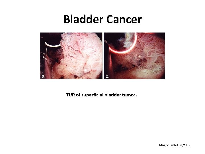Bladder Cancer TUR of superficial bladder tumor. Magdy Fath-Alla, 2009 