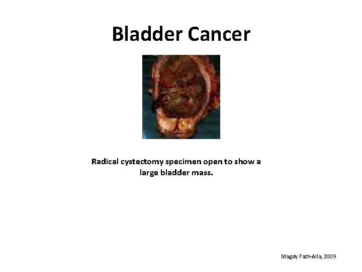 Bladder Cancer Radical cystectomy specimen open to show a large bladder mass. Magdy Fath-Alla,