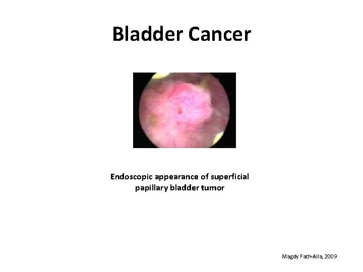 Bladder Cancer Endoscopic appearance of superficial papillary bladder tumor Magdy Fath-Alla, 2009 