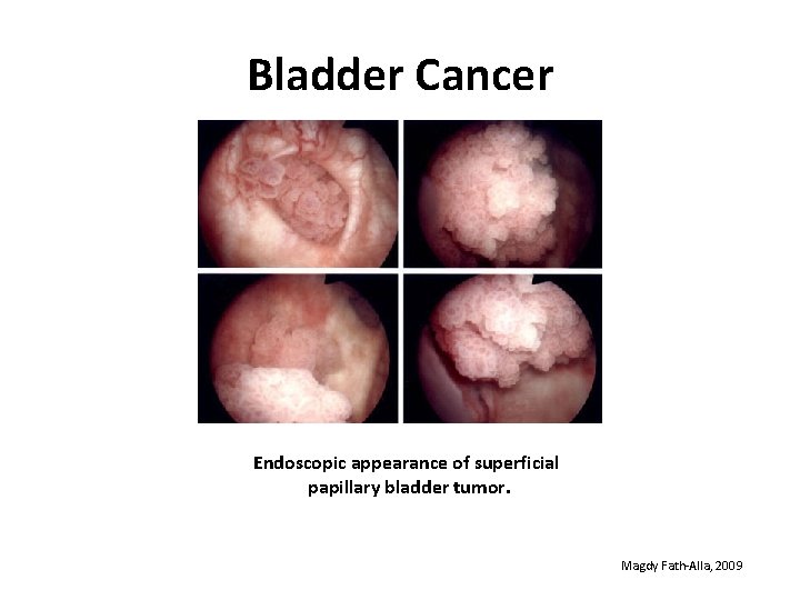 Bladder Cancer Endoscopic appearance of superficial papillary bladder tumor. Magdy Fath-Alla, 2009 