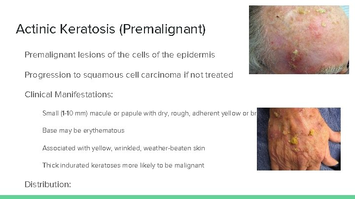 Actinic Keratosis (Premalignant) Premalignant lesions of the cells of the epidermis Progression to squamous