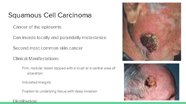 Squamous Cell Carcinoma Cancer of the epidermis Can invade locally and potentially metastasize Second