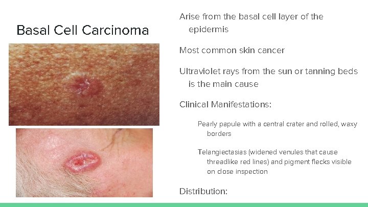 Basal Cell Carcinoma Arise from the basal cell layer of the epidermis Most common