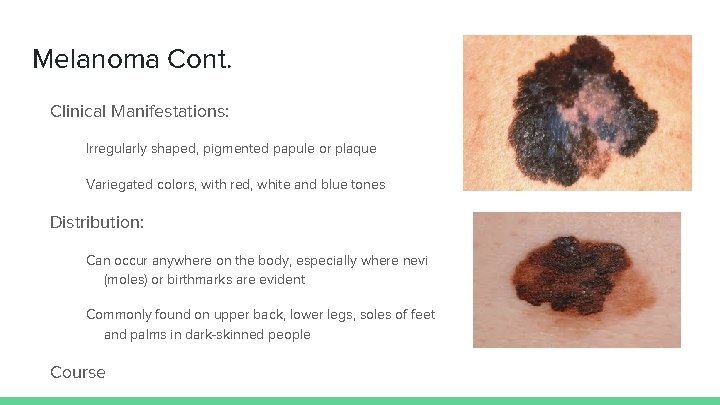 Melanoma Cont. Clinical Manifestations: Irregularly shaped, pigmented papule or plaque Variegated colors, with red,