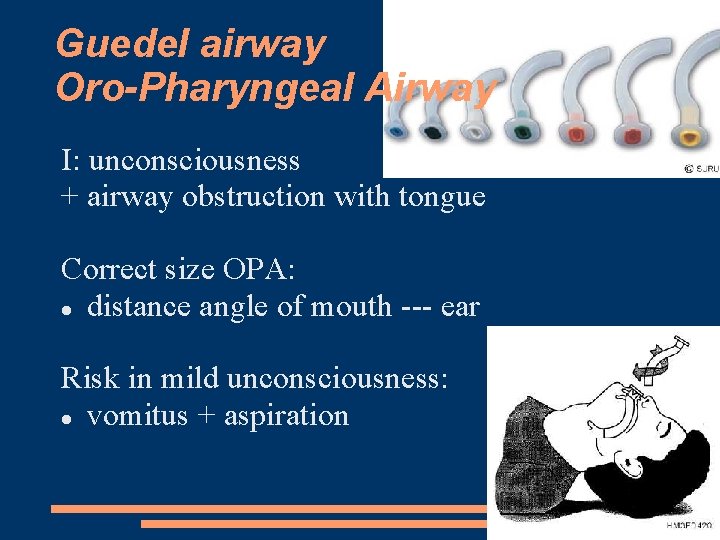 Guedel airway Oro-Pharyngeal Airway I: unconsciousness + airway obstruction with tongue Correct size OPA: