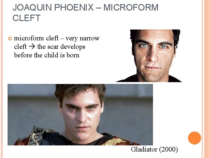 JOAQUIN PHOENIX – MICROFORM CLEFT microform cleft – very narrow cleft the scar develops