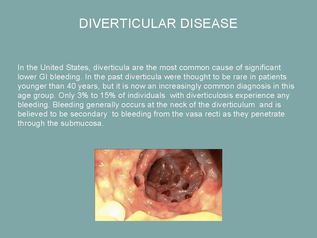DIVERTICULAR DISEASE In the United States, diverticula are the most common cause of significant