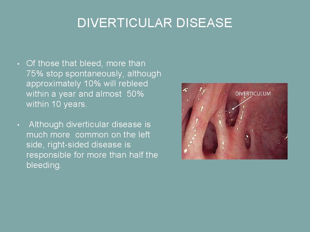 DIVERTICULAR DISEASE • Of those that bleed, more than 75% stop spontaneously, although approximately