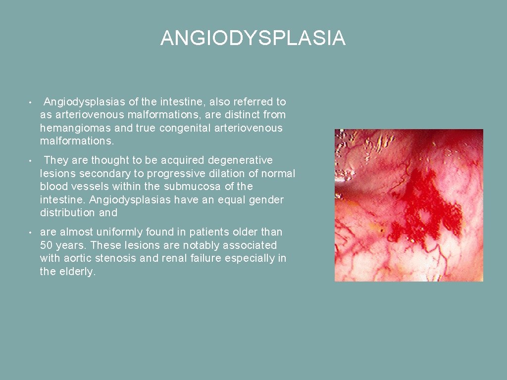 ANGIODYSPLASIA • Angiodysplasias of the intestine, also referred to as arteriovenous malformations, are distinct