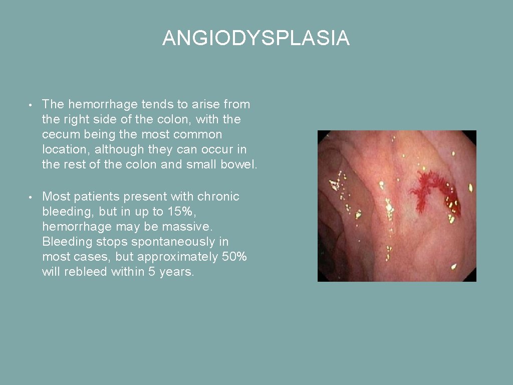 ANGIODYSPLASIA • The hemorrhage tends to arise from the right side of the colon,