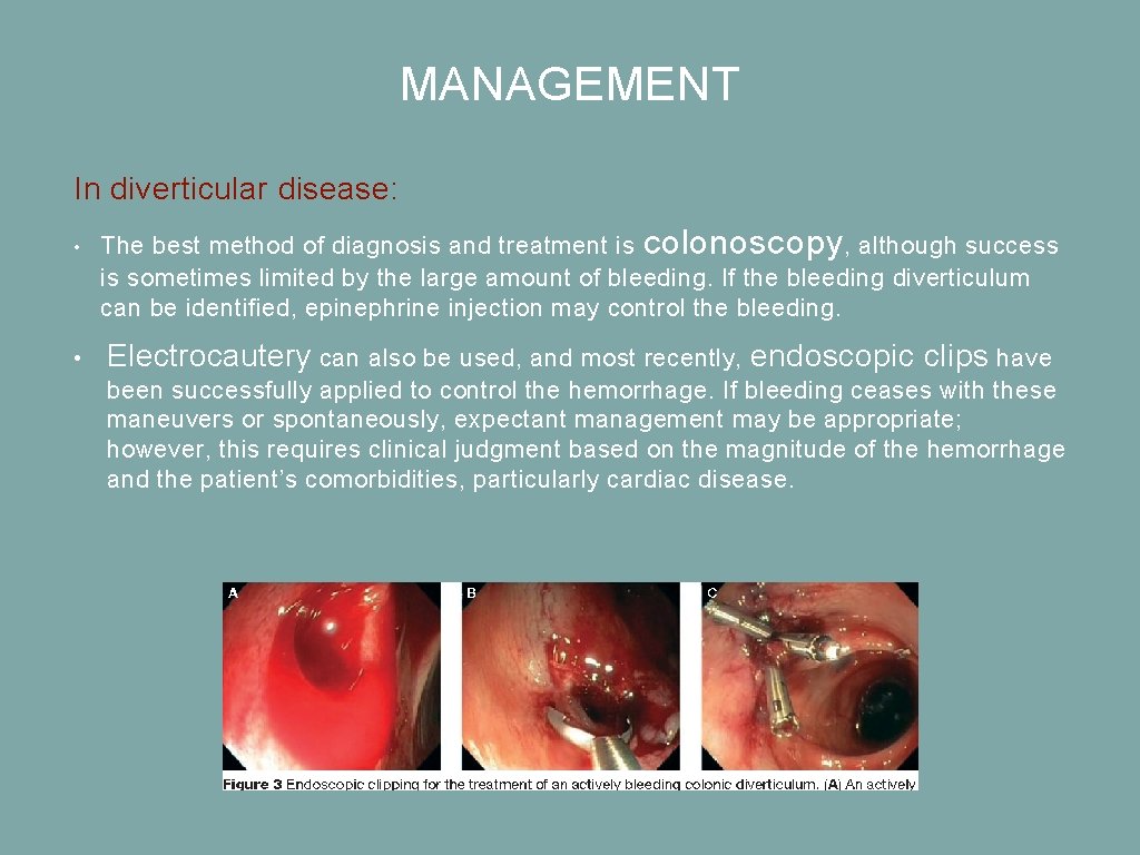 MANAGEMENT In diverticular disease: • • The best method of diagnosis and treatment is