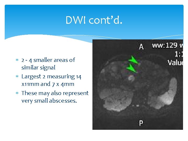 DWI cont’d. 2 - 4 smaller areas of similar signal Largest 2 measuring 14