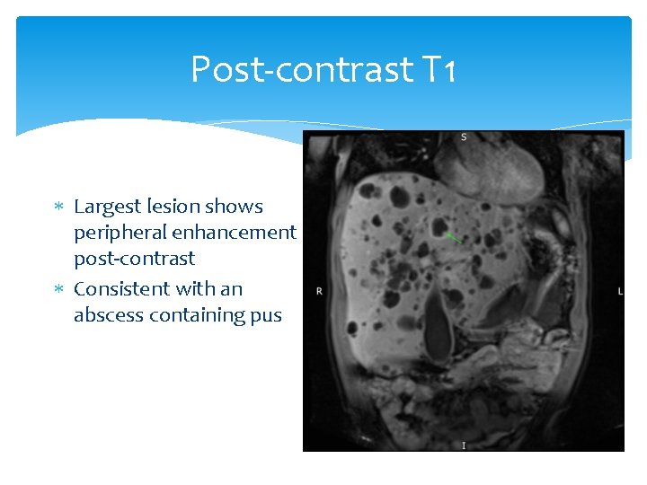 Post-contrast T 1 Largest lesion shows peripheral enhancement post-contrast Consistent with an abscess containing