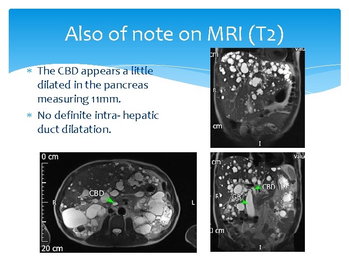 Also of note on MRI (T 2) The CBD appears a little dilated in
