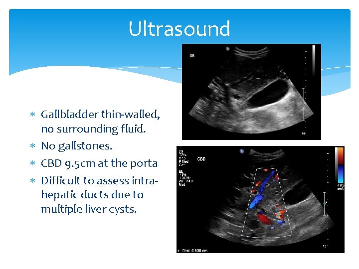 Ultrasound Gallbladder thin-walled, no surrounding fluid. No gallstones. CBD 9. 5 cm at the