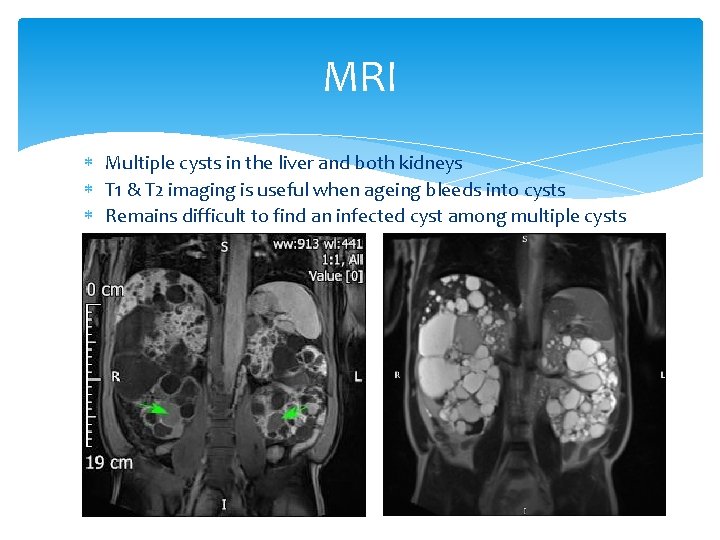 MRI Multiple cysts in the liver and both kidneys T 1 & T 2