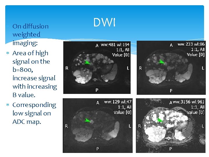  On diffusion weighted imaging: Area of high signal on the b=800, increase signal