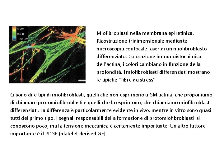 Miofibroblasti nella membrana epiretinica. Ricostruzione tridimensionale mediante microscopia confocale laser di un miofibroblasto differenziato.