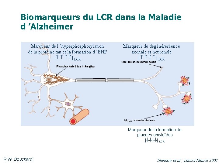 Biomarqueurs du LCR dans la Maladie d ’Alzheimer Marqueur de l ’hyperphosphorylation de la