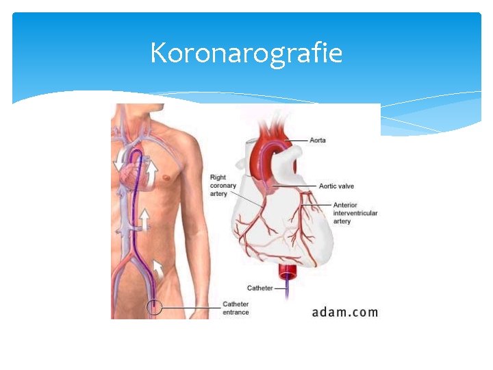 Koronarografie 