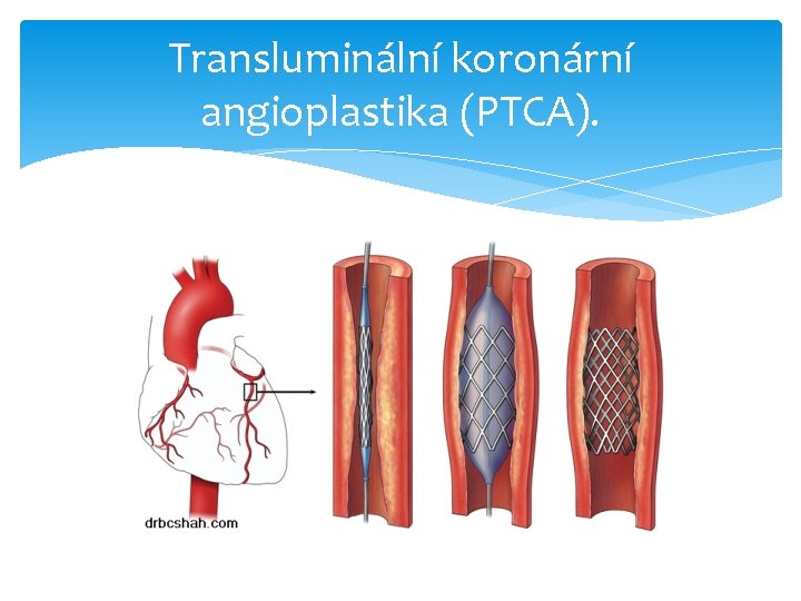 Transluminální koronární angioplastika (PTCA). 