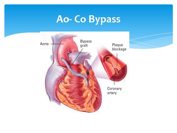 Ao- Co Bypass 