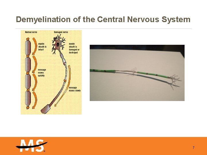 Demyelination of the Central Nervous System 7 