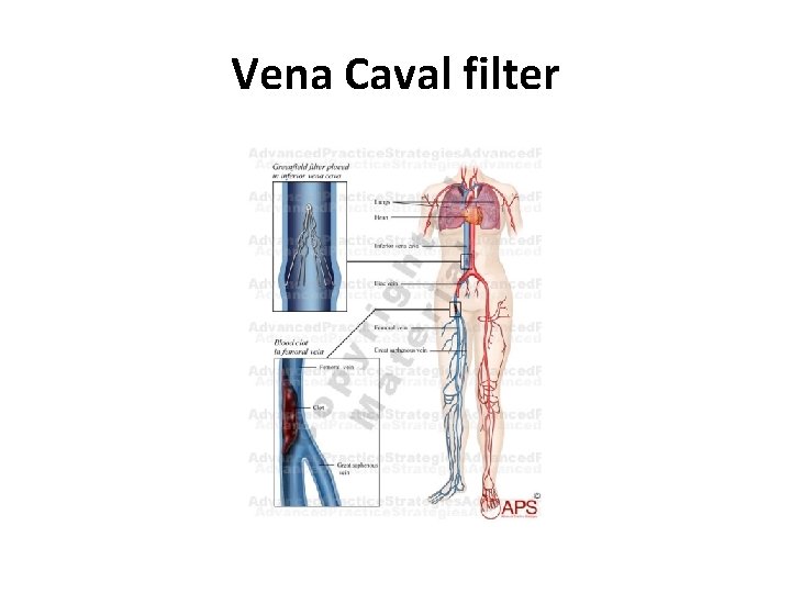 Vena Caval filter 