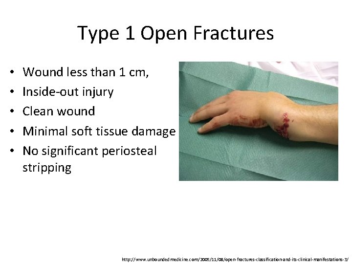 Type 1 Open Fractures • • • Wound less than 1 cm, Inside-out injury