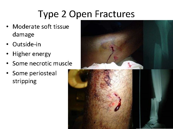 Type 2 Open Fractures • Moderate soft tissue damage • Outside-in • Higher energy