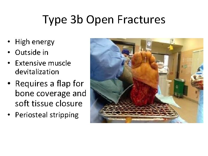 Type 3 b Open Fractures • High energy • Outside in • Extensive muscle