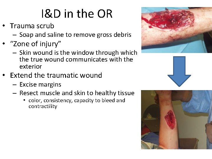 I&D in the OR • Trauma scrub – Soap and saline to remove gross