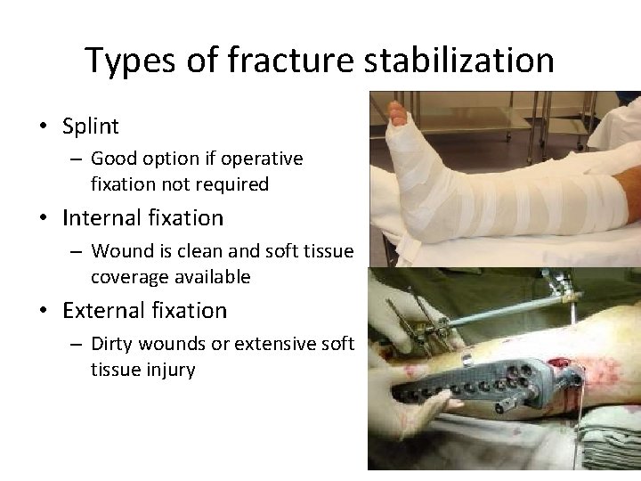 Types of fracture stabilization • Splint – Good option if operative fixation not required