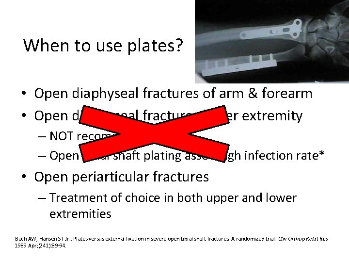 When to use plates? • Open diaphyseal fractures of arm & forearm • Open