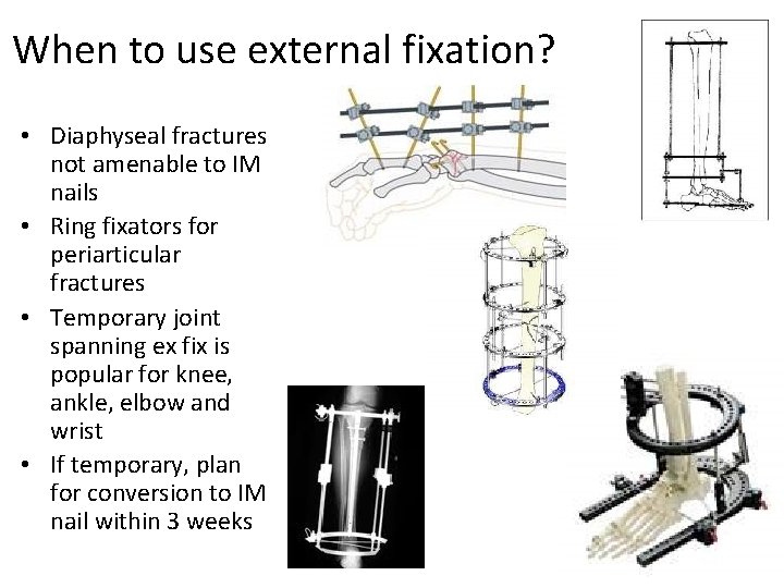 When to use external fixation? • Diaphyseal fractures not amenable to IM nails •