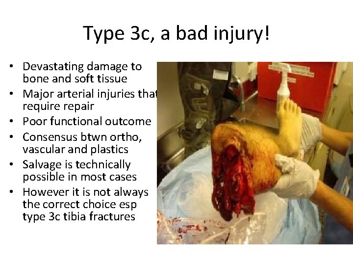Type 3 c, a bad injury! • Devastating damage to bone and soft tissue