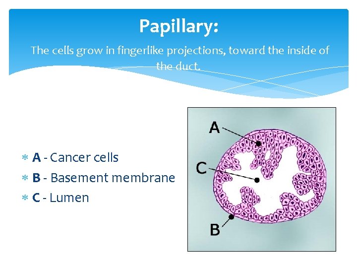 Papillary: The cells grow in fingerlike projections, toward the inside of the duct. A
