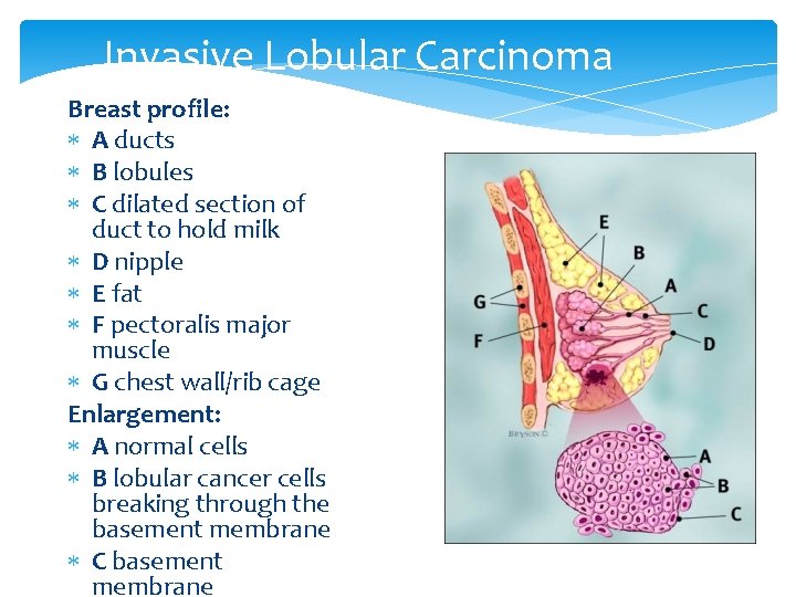 Invasive Lobular Carcinoma Breast profile: A ducts B lobules C dilated section of duct
