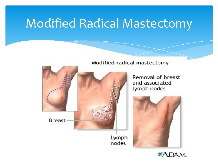 Modified Radical Mastectomy 